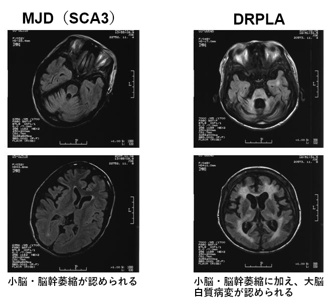 頭部MRI