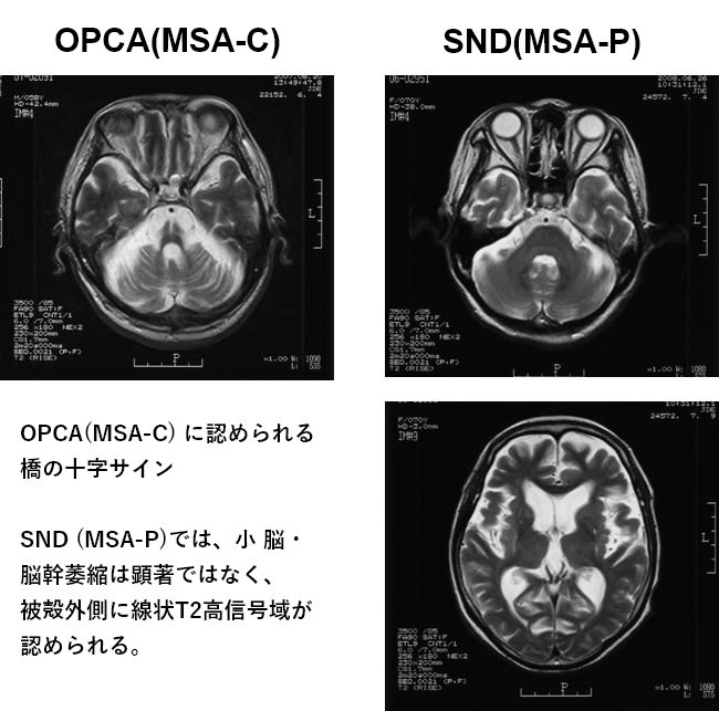 頭部MRI画像